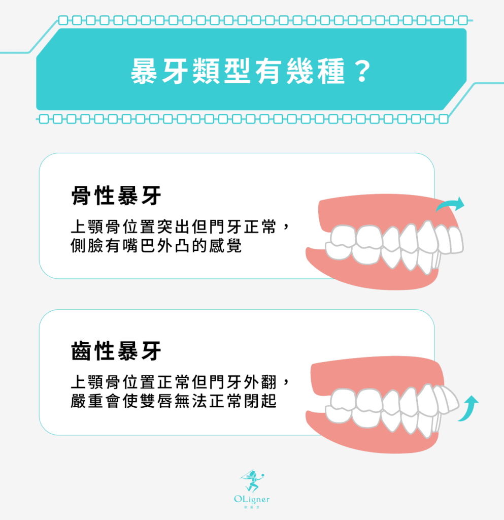 骨性暴牙：上顎骨位置突出但門牙正常，側臉有嘴巴外凸的感覺
齒性暴牙：上顎骨位置正常但門牙外翻，嚴重會使雙唇無法正常閉起
