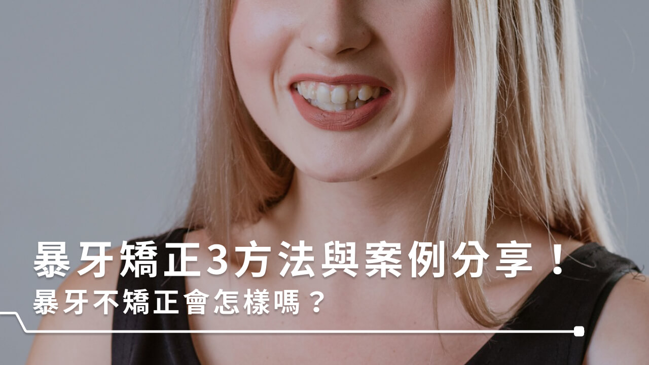 暴牙矯正3方法與案例分享！暴牙不矯正會怎樣嗎？