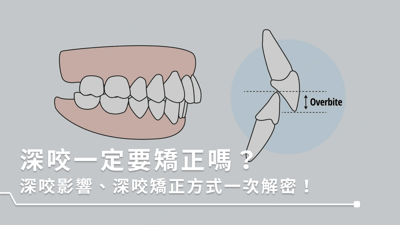 深咬一定要矯正嗎？深咬影響、深咬矯正方式一次解密！